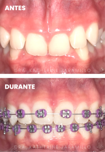 ortodoncia exitosa 11