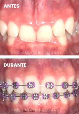 ortodoncia exitosa 11