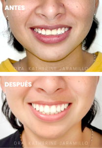 ortodoncia exitosa 14