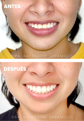 ortodoncia exitosa 14