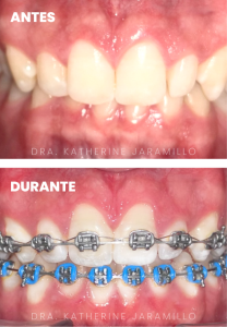 ortodoncia exitosa 17