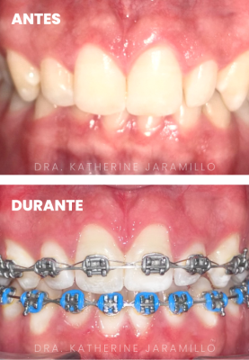ortodoncia exitosa 17
